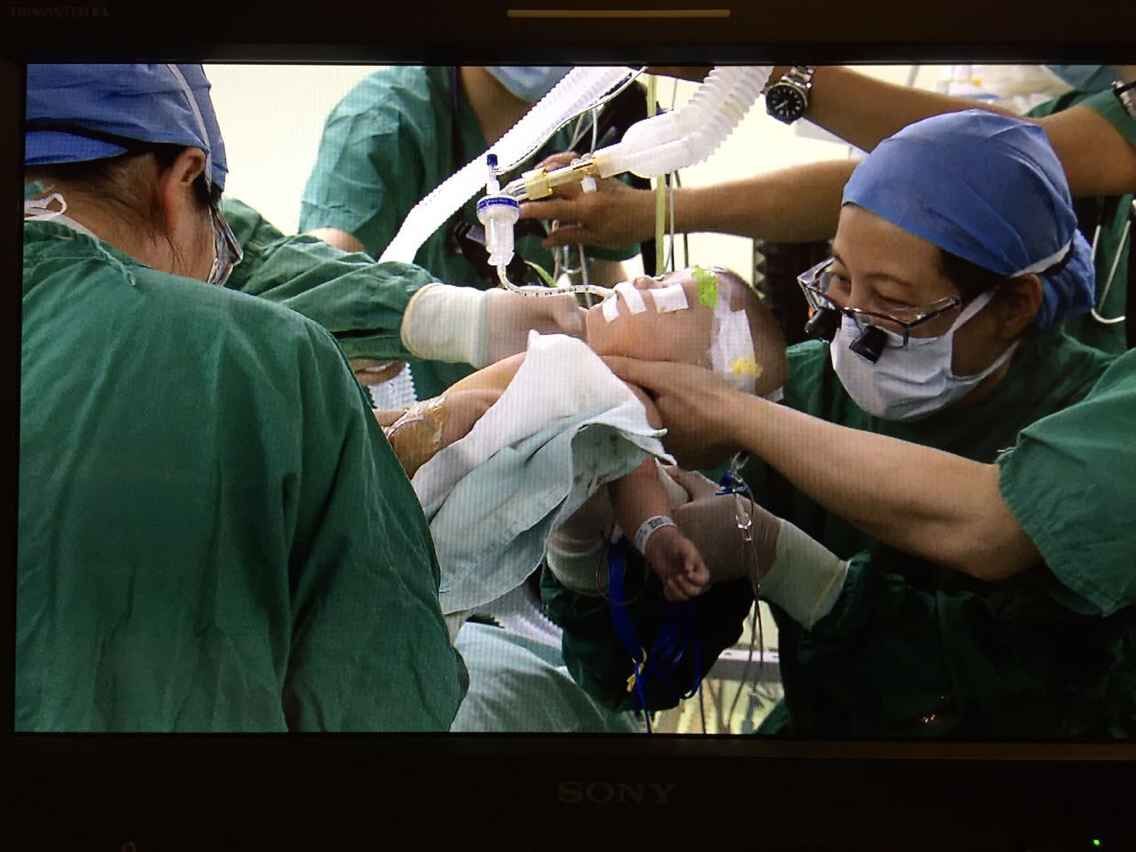 连体双胞胎姐妹9日成功在上海进行分离手术
