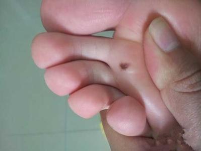 足疗引发黑痣癌变成恶性瘤网友感叹保健不成惹祸上身