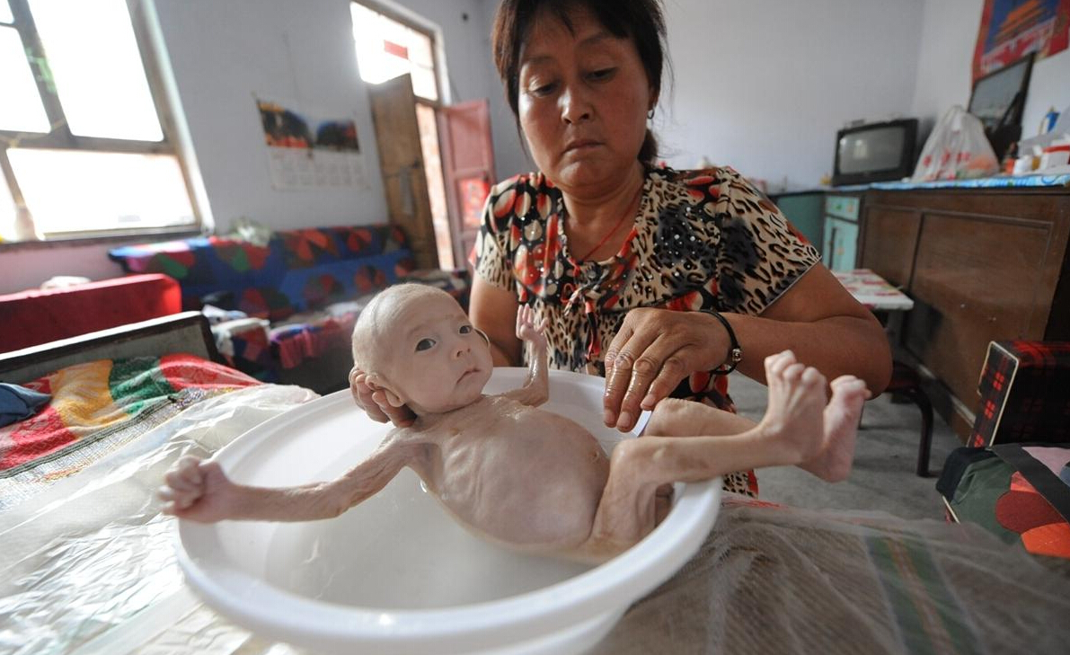 无肛男婴酷似外星人 出生80天仅4.8斤