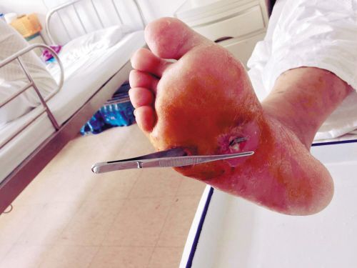 男子脚掌扎根小刺自行消毒 一个月后截肢保命