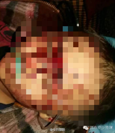 湖南:6岁男童遭砍十多刀 3根手指被砍断(图)