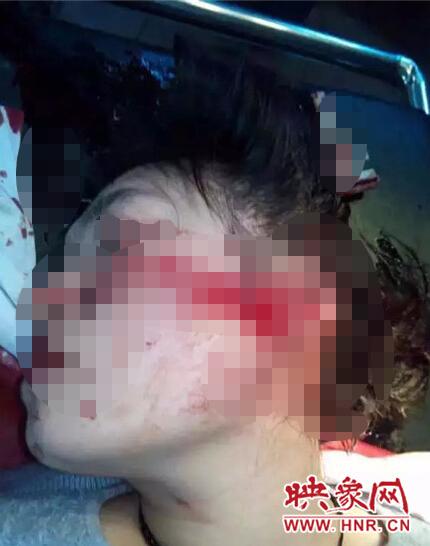 河南一年轻女医生被砍 身中七刀在ICU抢救