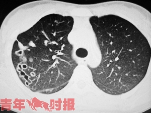 女子患肺吸虫病 按肺结核病治疗3年无效